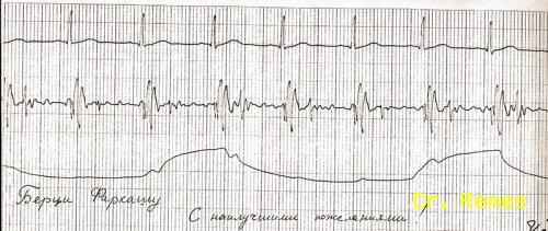 Farkas Bertalan EKG-ja, légzése és szeizmokardiogramja Bajkonurban 1980. május 26-án - forrás: Dr. Remes