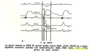 EKG II. elv., carotis görbe, PKG, dC/dT, és deriváltja, EMS, PEP, EML, ICP, LVET