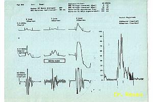 Marquette Elektronics Hi-Res EKG egy protokollja